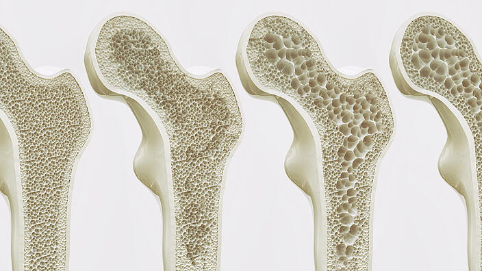 Vier Längsschnitte eines Knochens in unterschiedlichen Stadien der Osteoporose